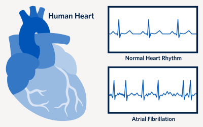 Graphic depicting normal heart rhythm versus atrial fibrillation