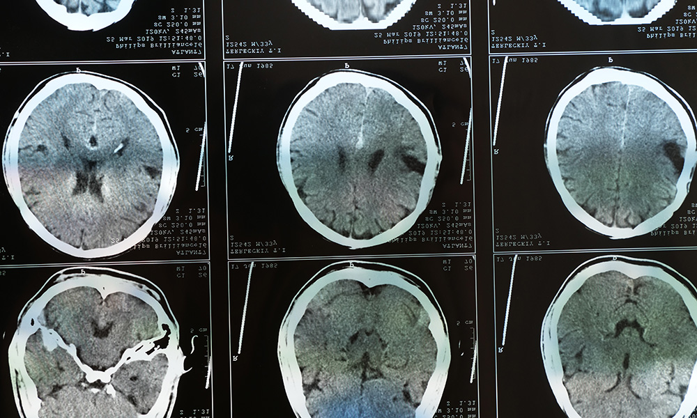 An MRI of a brain after trauma